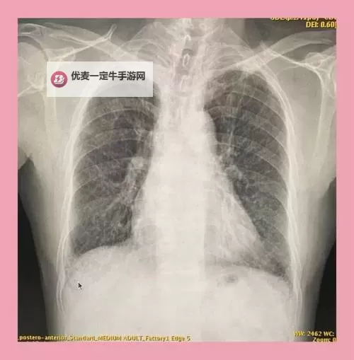 100胸片曝光率可以直接看免费：轻松获取医疗影像资源图1